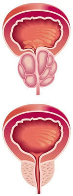 The prostate before and after the application of Prospero