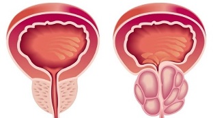 causes of the development of prostatitis and prostate adenoma